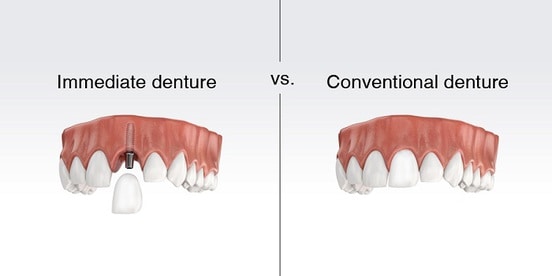 Benefits from Denture Replacement